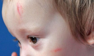 Соцсети: В Пензе ребенок вернулся из детского сада с синяками и гематомами 