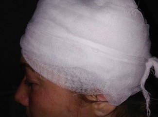 Появились подробности нападения на женщину в Арбеково, которой пытались выколоть глаза