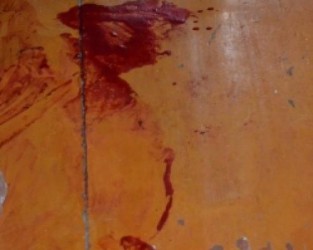 Жителю Пензы проткнули легкое во время вечеринки